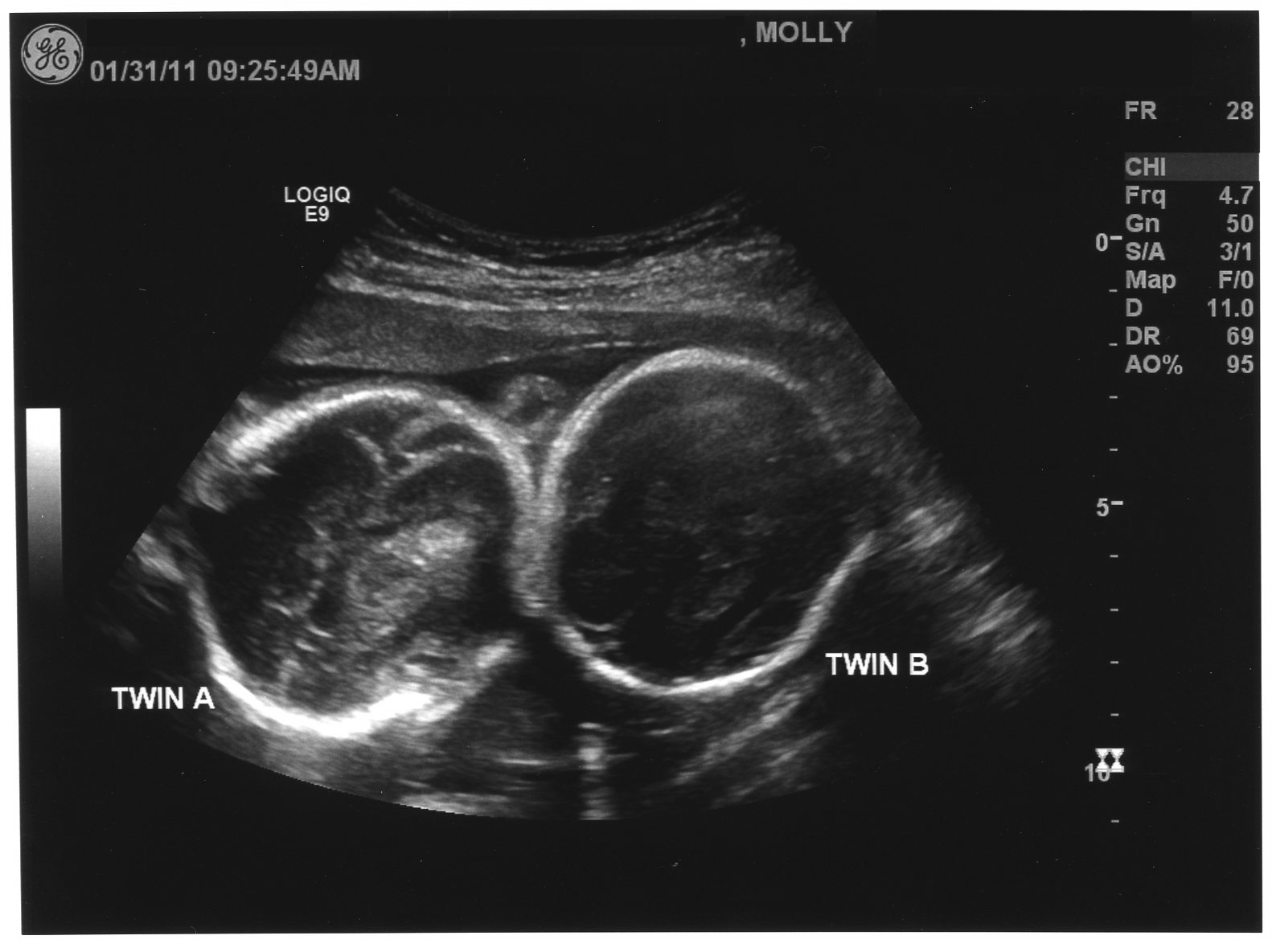 sonogram of twins at 8 weeks
